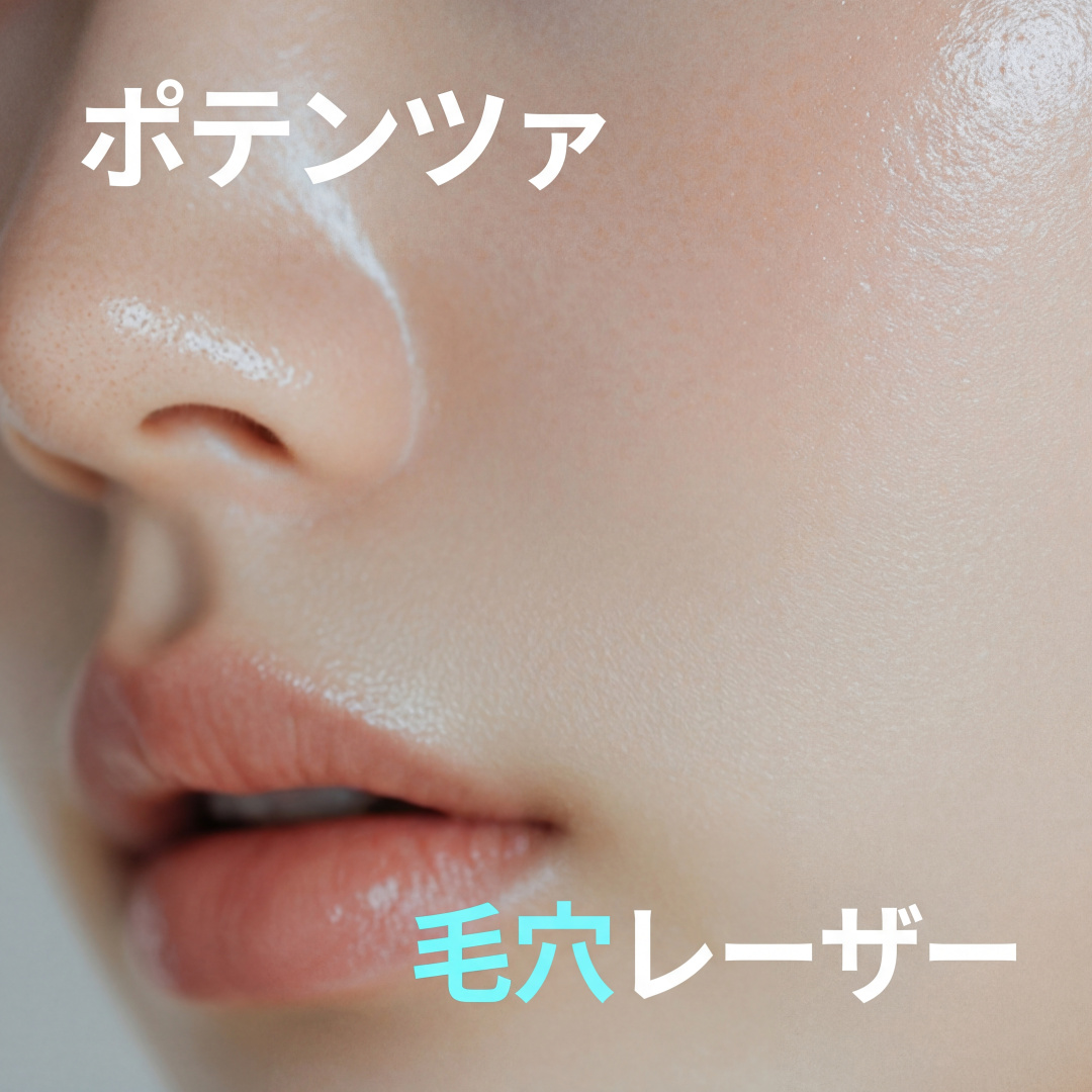 ポテンツァ 高周波レーザー1回 - 皮膚管理、毛穴縮小、ニキビ跡＆赤ら顔改善、皮膚弾力強化、小ジワ除去
