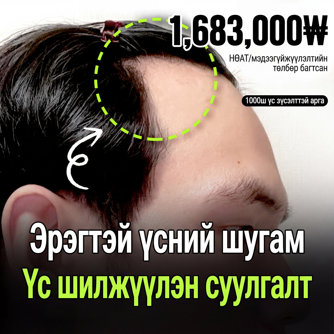 Idol үсний шугам суулгах