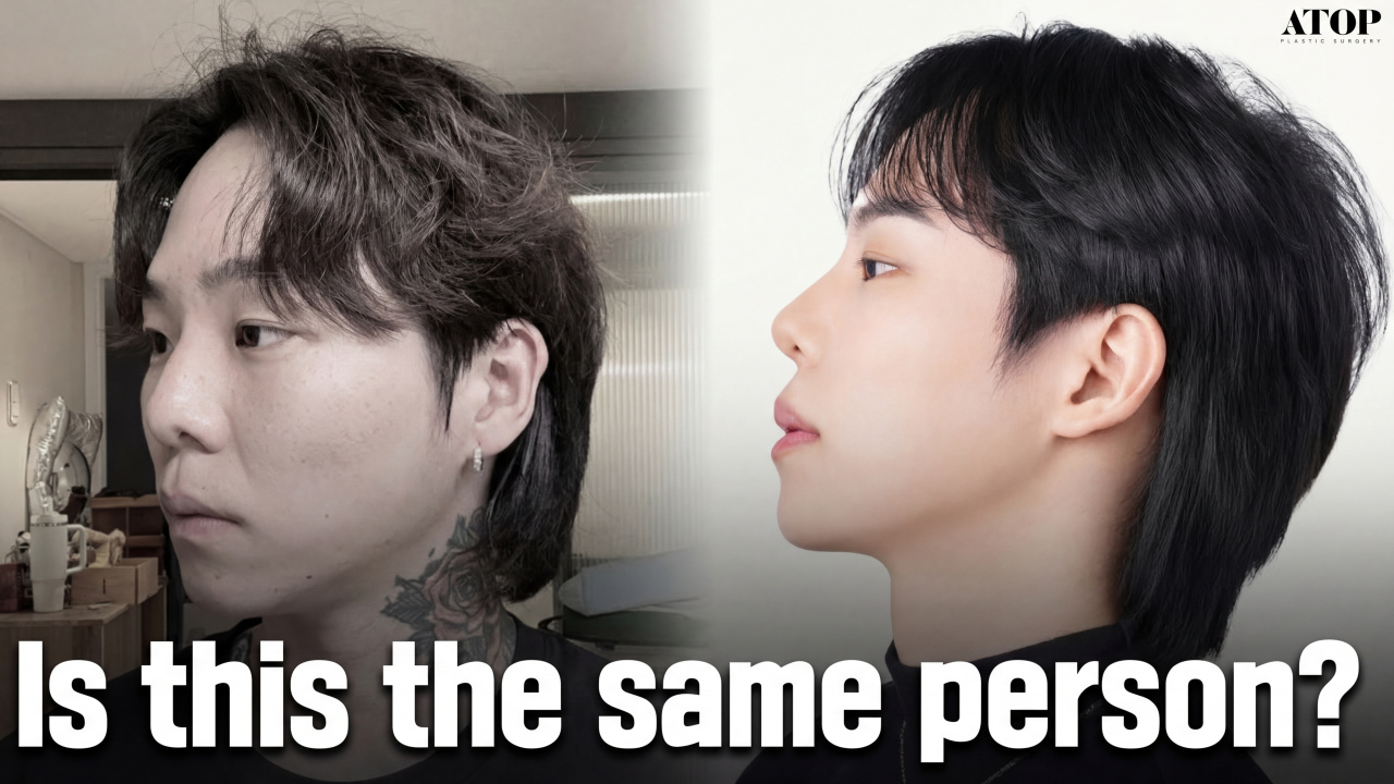 Men's Rhinoplasty: The Subtle Difference (3 Months Post-Op)