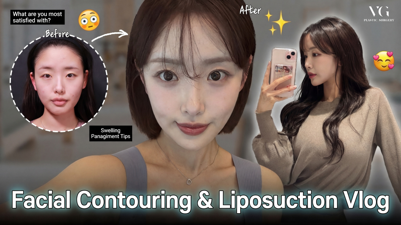 Facial Contouring (3 Types) & Liposuction Honest Review VLOG✨ I Surgery Review I VLOG I Facial Contouring I Abdominal Lipo I