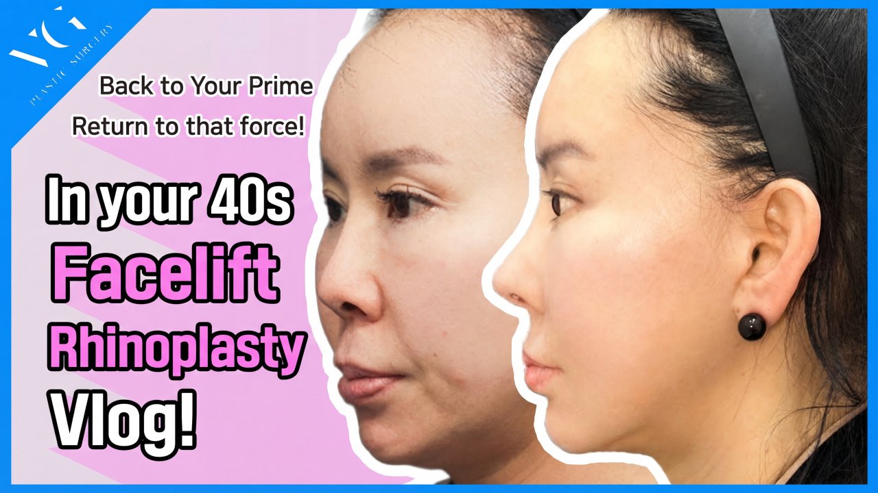 I got my youth back with a facelift! | Real 3-month post-op review