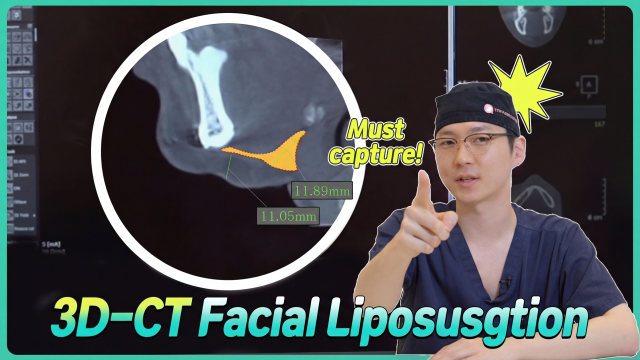 Wait! Before Bone Contouring, Don't Miss '3D-CT Facial Liposuction'. Get a Small Face Burden-Free!! ✌ ATOP Plastic Surgery (feat. Dr. Son