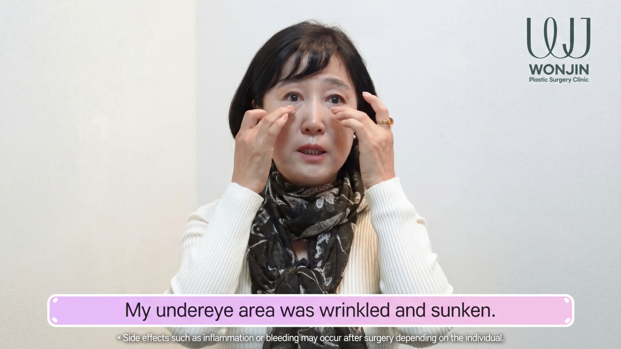 60s Anti-Aging Surgery Before & After Big Reveal | Real Story Honest Review 😊
