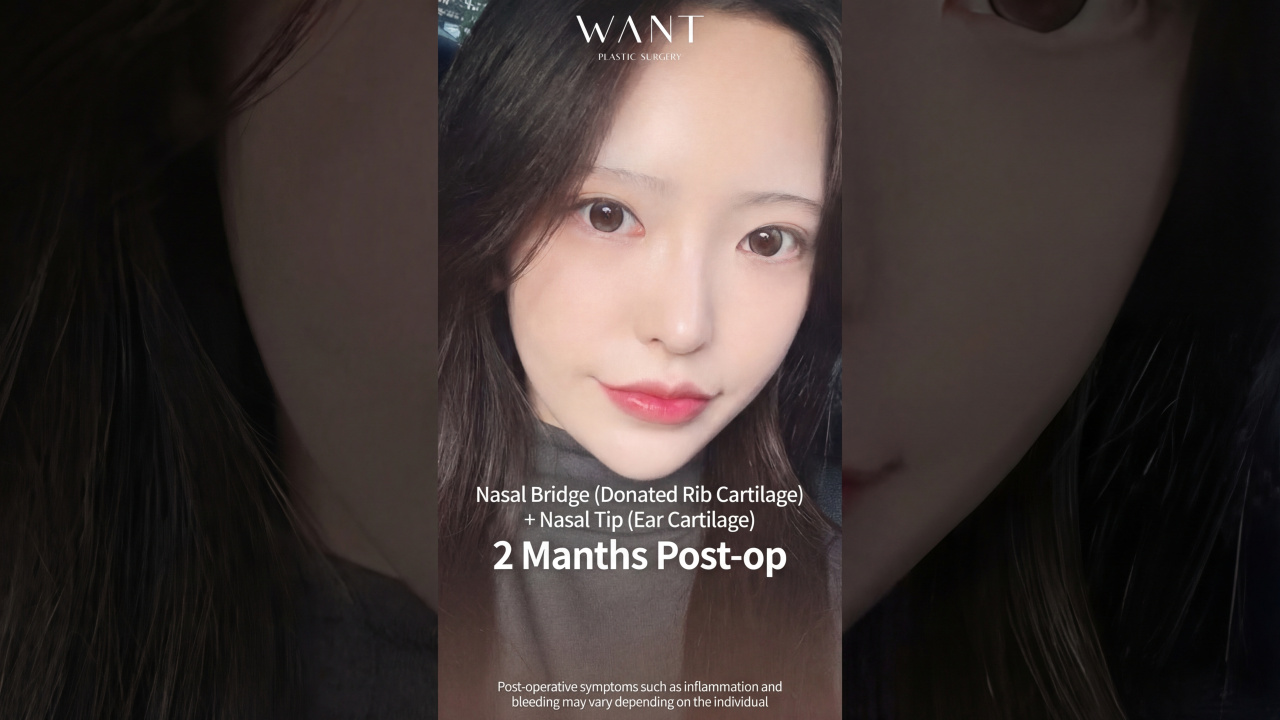 All I did was get a nose job, but look at this total vibe change?!🥰🥰 Primary + Bridge + Tip + Donated Rib + Ear Cartilage + Implant #shorts #selfie