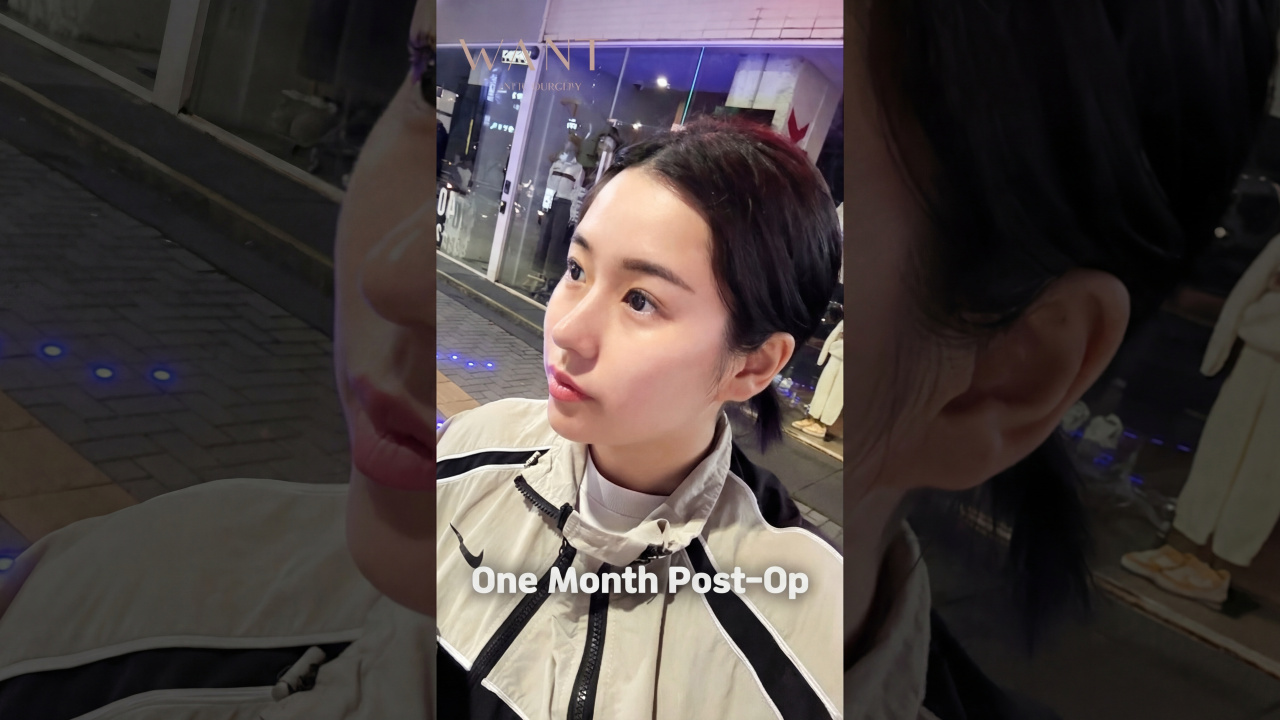 Primary Rhinoplasty + No Implant (Autologous Rib) + Hump & Bulbous Nose Correction. I decided to get surgery because of my hump and low nose, but isn't it