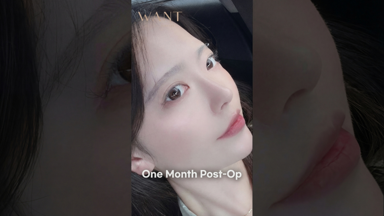 I just got my nose done, but my whole face looks so much more defined..💖💖💖 Primary Rhinoplasty + Bridge + Tip + Donated Rib + Ear Cartilage + Implant #shorts #