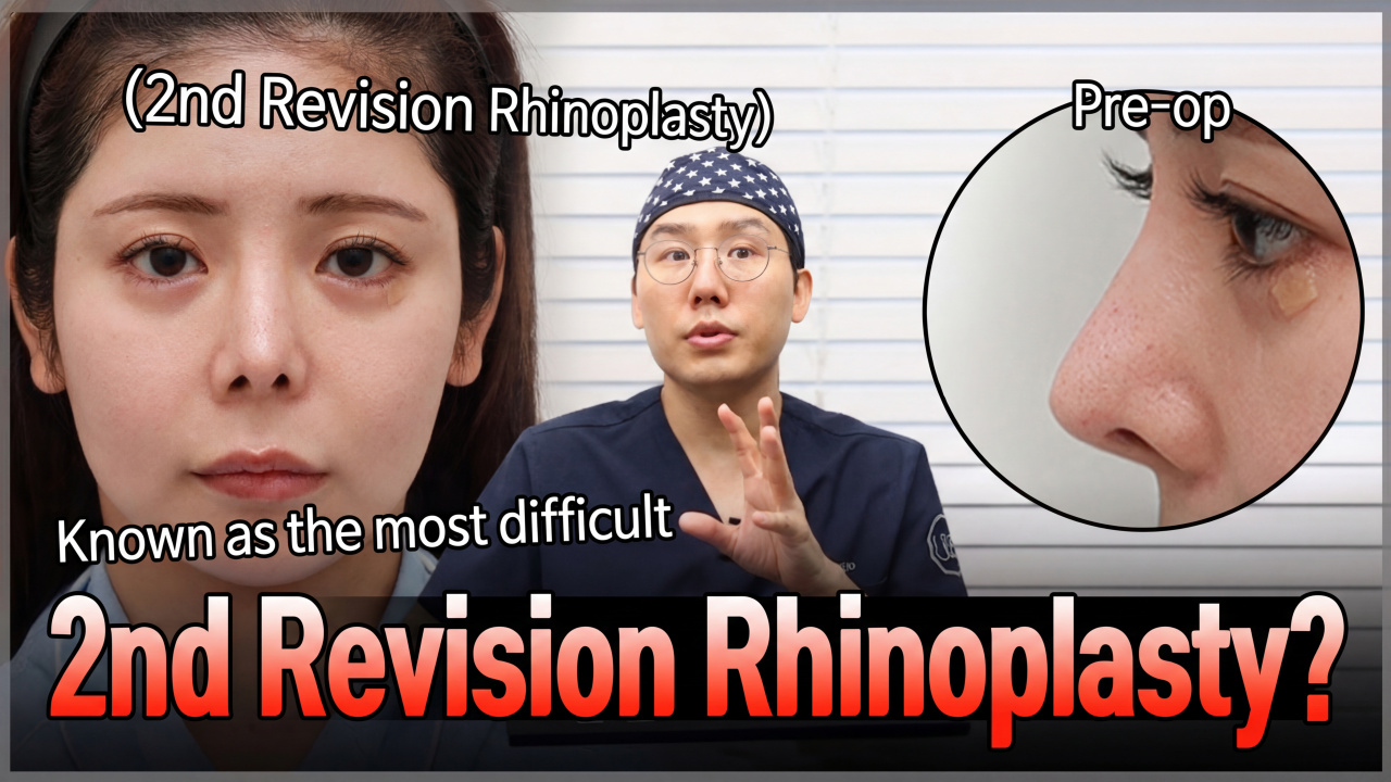 Is Revision Rhinoplasty Really the Most Difficult?😭