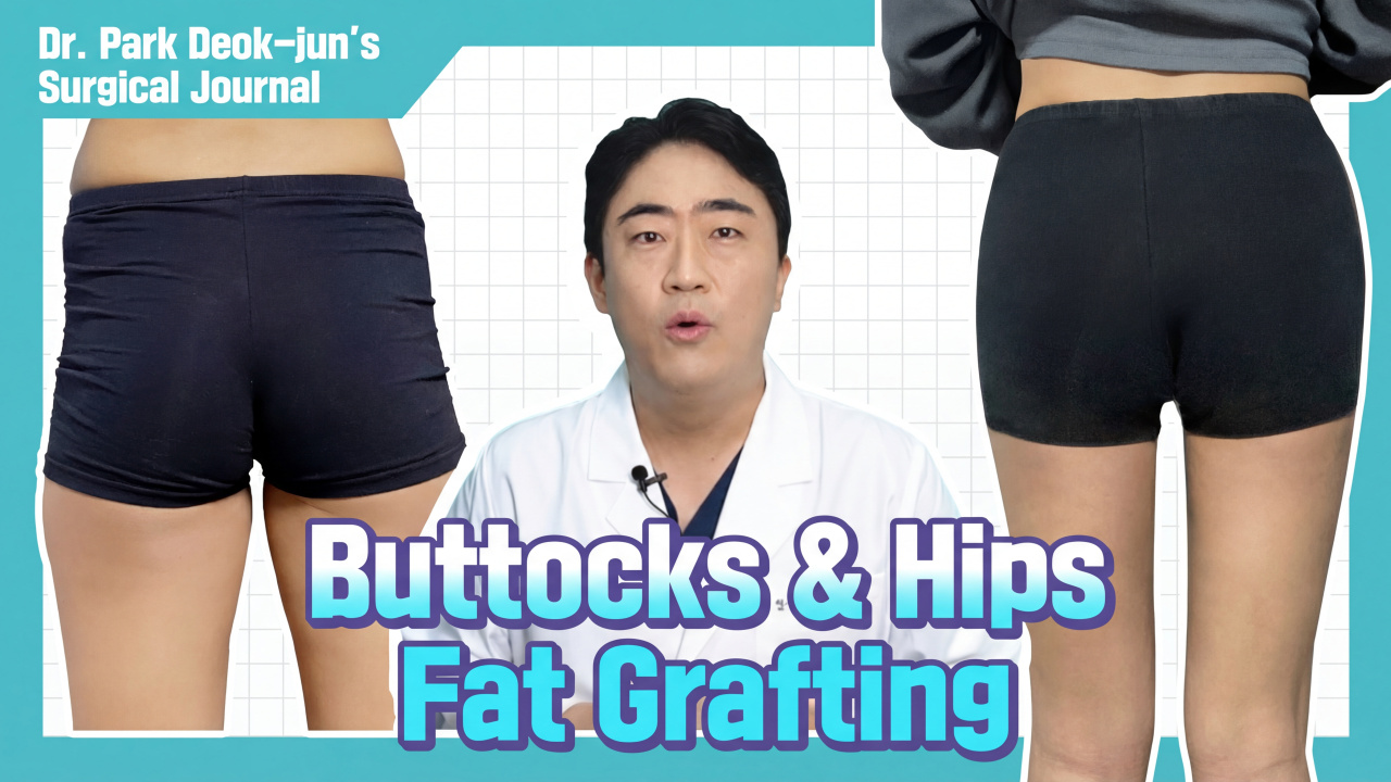 [Surgery Log] Real Case: Butt Fat Grafting Before & After❗ Must Watch Before Liposuction l Girin Plastic Surgery #FatGraftingReview #LiposuctionReview
